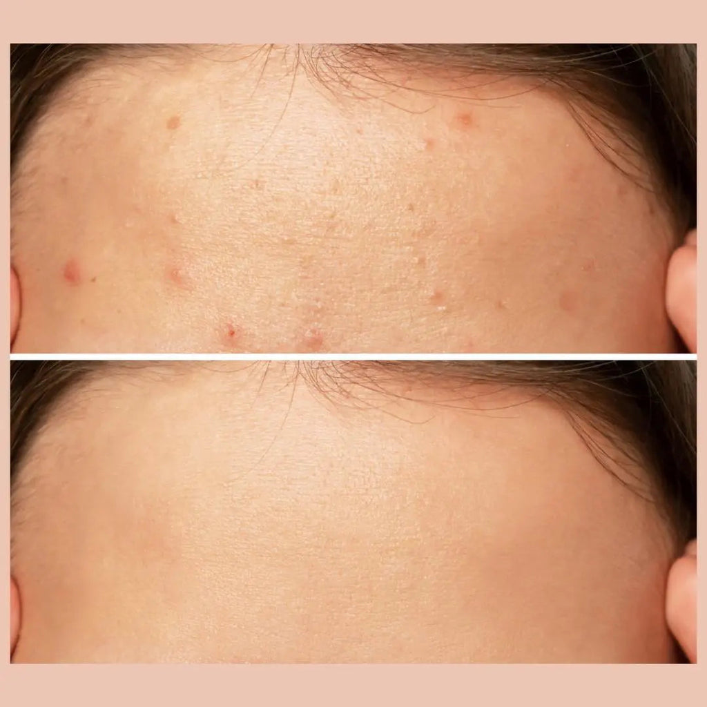 Eclear Acne Control Serum 20mL aftechskincare